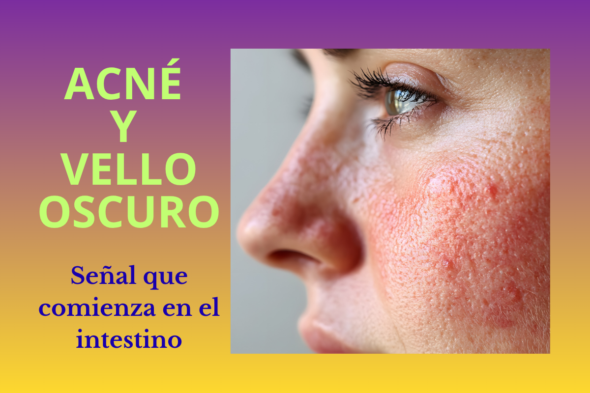 “Acné persistente y aparición de vello oscuro relacionados con desequilibrio intestinal y hormonal en la mujer adulta.”